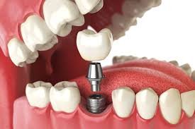 Best Dental Implant Surgeon in Kanpur