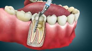 Best Root Canal Specialist in Kalyanpur