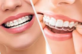 Best Clear Aligners in Kanpur