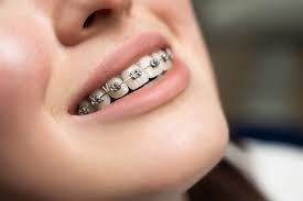 Best Dental Braces in Kalyanpur