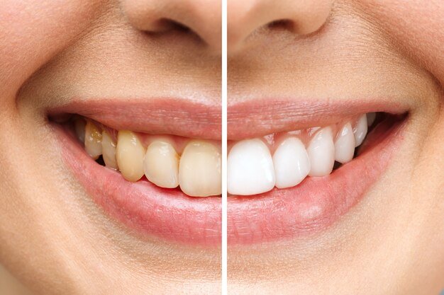 Best Tooth Whitening Center in Kanpur