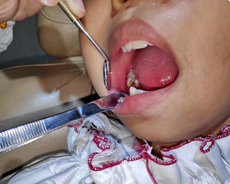 Best Oral Cysts and Tumors Treatment in Kanpur