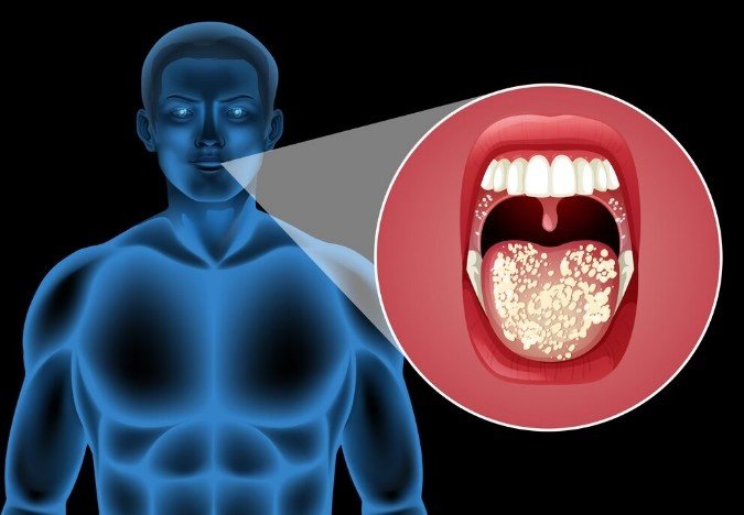 Best Doctor for Oral Cancer in Kanpur