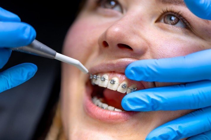 Best Dental Braces Services in Kanpur