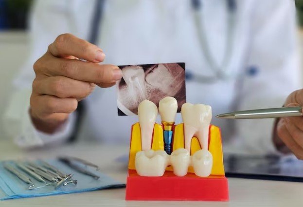 Best Fixed Dental Crown and Bridge in Kanpur