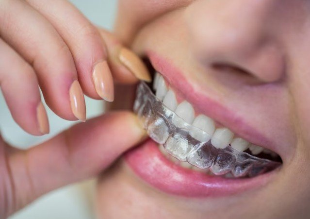 Patient smiling while using the Best Clear Aligners Care in Indira Nagar