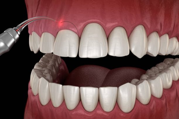 Gingivectomy surgery with laser using.  Medically accurate tooth 3D illustration