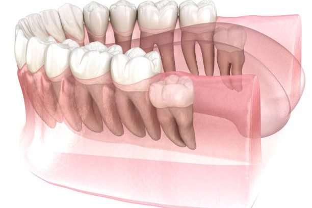 Vertical impaction of Wisdom tooth. Medically accurate tooth 3D illustration